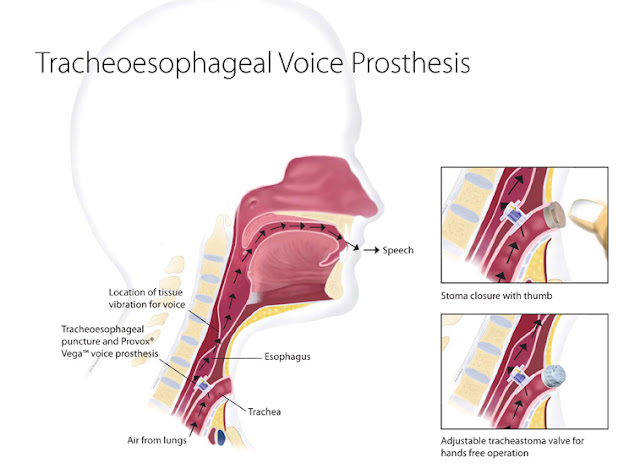 laryngectomy speech laryngectomy speech